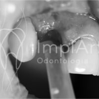 Vídeo: cirurgia de implante dentário