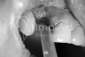 cirurgia_de_implante_dentario