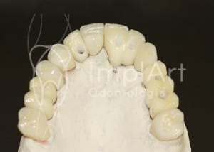 dente de zirconia