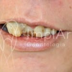 fumo_e_implante_dentario