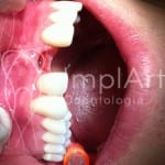 gengival implante dentario estetico