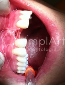 gengival implante dentario estetico