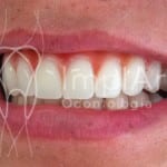 implante dental protese