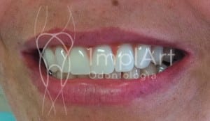 implante dentario carga rápida