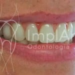 implante dentario fixo