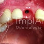 implante dentario gengiva