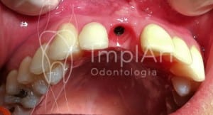 implante dentario gengiva