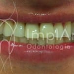 implante dentario provisorio