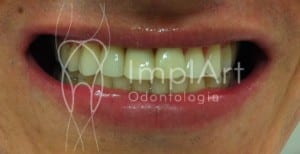 implante dentario provisorio
