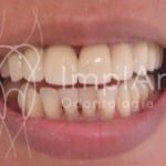 implante_de_dente_boca_toda