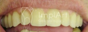 implante_dental_total