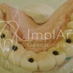 implante_dentario_1