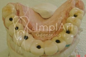 implante_dentario_1