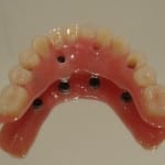 implante_dentario_2