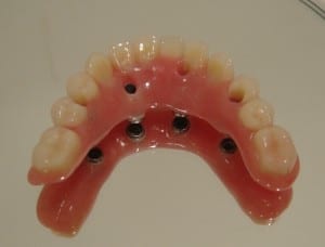 implante_dentario_2