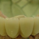 implante_dentario_3