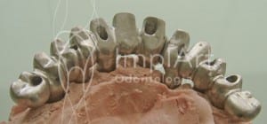 implante_dentario_porcelana___estrutura_metalica1