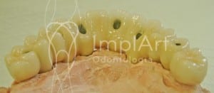 implante_dentario_Metaloceramica___porcelana_aplicada