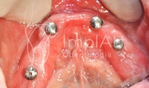 implantes dentario