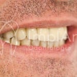 implante_dentario_carga_imediata