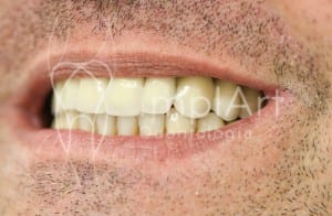 implante_dentario_carga_imediata