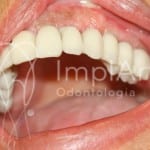 implante_dentario_fixo