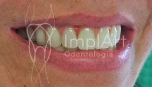 implante_dentario_fixo_1