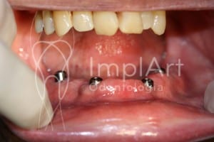 implante_dentarios