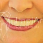 implante_odontologico implante_dental
