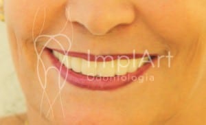 implante_odontologico implante_dental