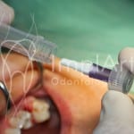 cirurgia de implante