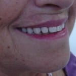 implantes_dentarios2_1