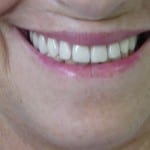 implantes_dentarios3_1