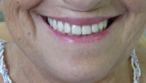 implantes_dentarios3_1