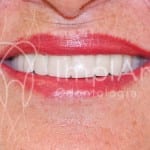 implantes_odontologicos