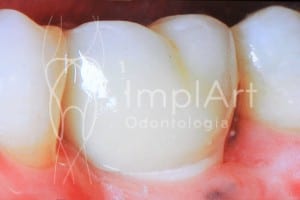 implantes_zirconia