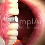 molde_de_implante_dentario