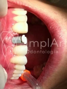 molde_de_implante_dentario