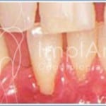 tratamento periodontal