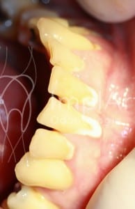 periodontal3