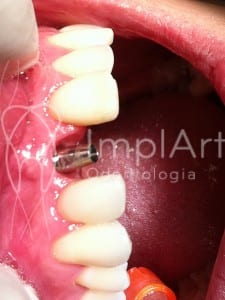 pilar metalico implante dentario