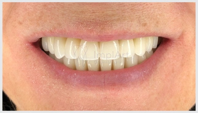 A estética dental na reabilitação oral com zircônia