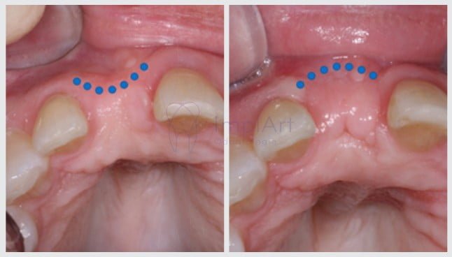 Técnica Summers – enxerto ósseo dentário e implante juntos