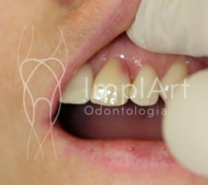 implante dentario