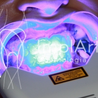 Clareamento dentário – antes ou depois da prótese dental
