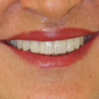 Implante dentário da arcada toda recupera a estética e mordida