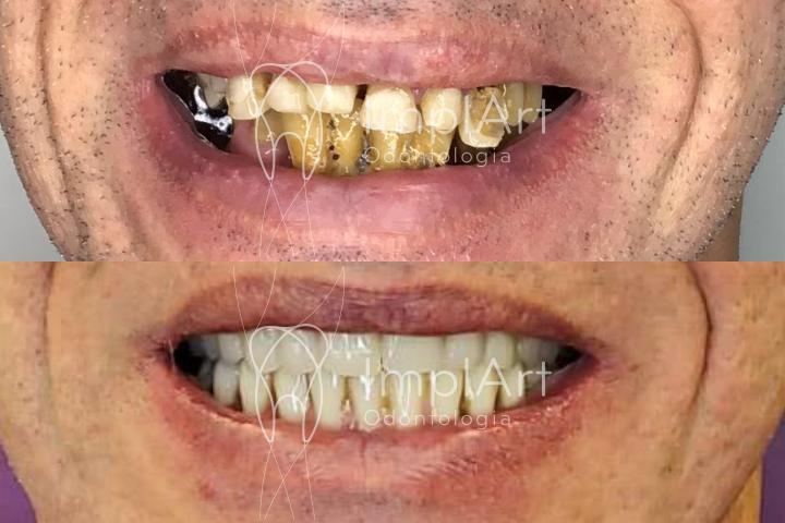 reabilitacao oral completa implantes protese metaloplastica antes depois 49kb