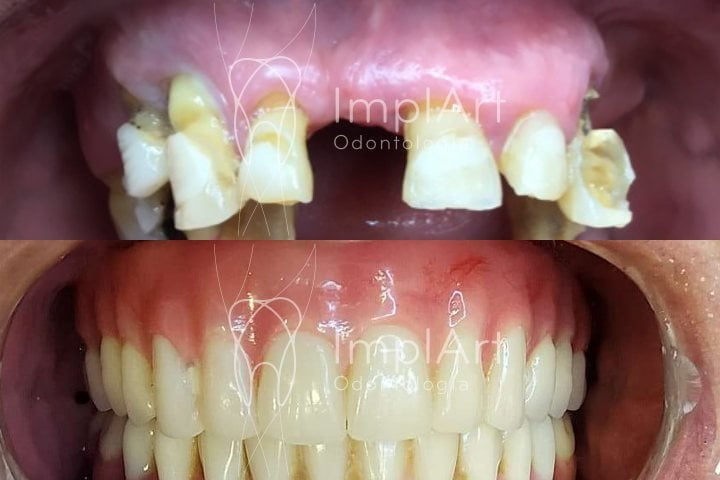 reabilitacao oral completa implantes protese metaloplastica antes depois 50kb