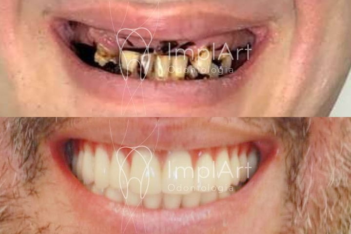 reabilitacao oral implantes protese metaloplastica 50kb
