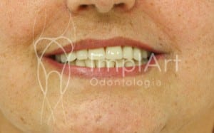 implante_dentario_total_resina